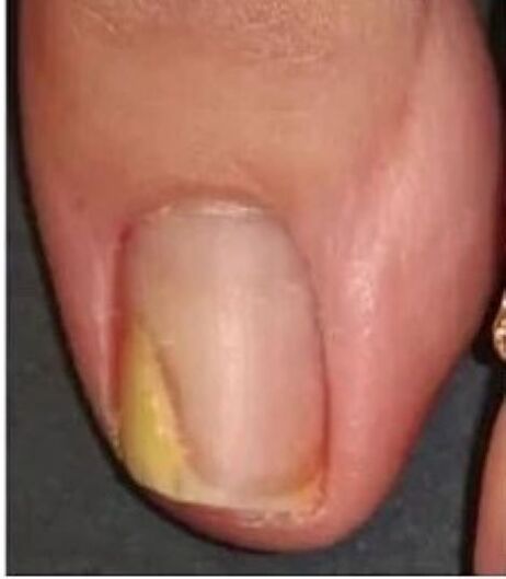 ноктите на нозете со габа пред третманот