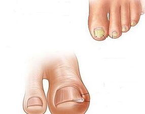 прогресија на габата на ноктите на нозете