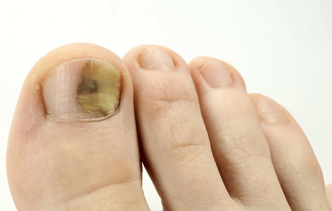 габична инфекција на ноктите
