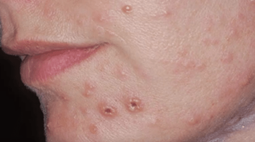 Габична инфекција на кожата на лицето