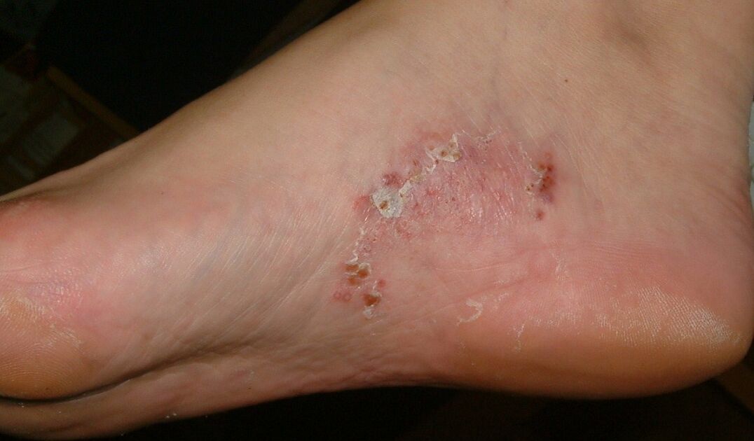 Манифестации на габична инфекција на стапалото