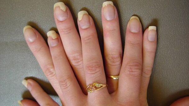 Ноктите на прстите погодени од габична инфекција